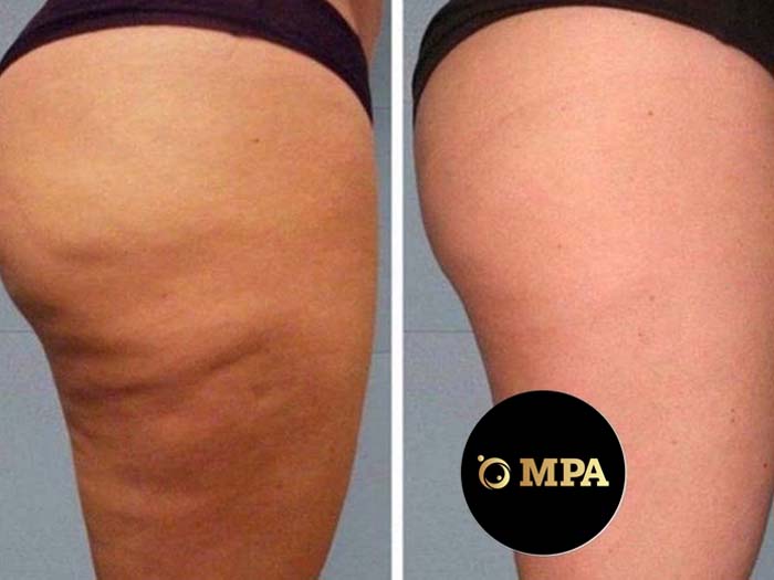 Cellulite Reduction